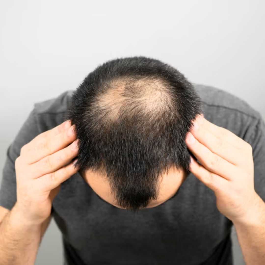 A New Dawn: The Cure For Male Pattern Baldness Is Here – Clascoterone Changes Everything